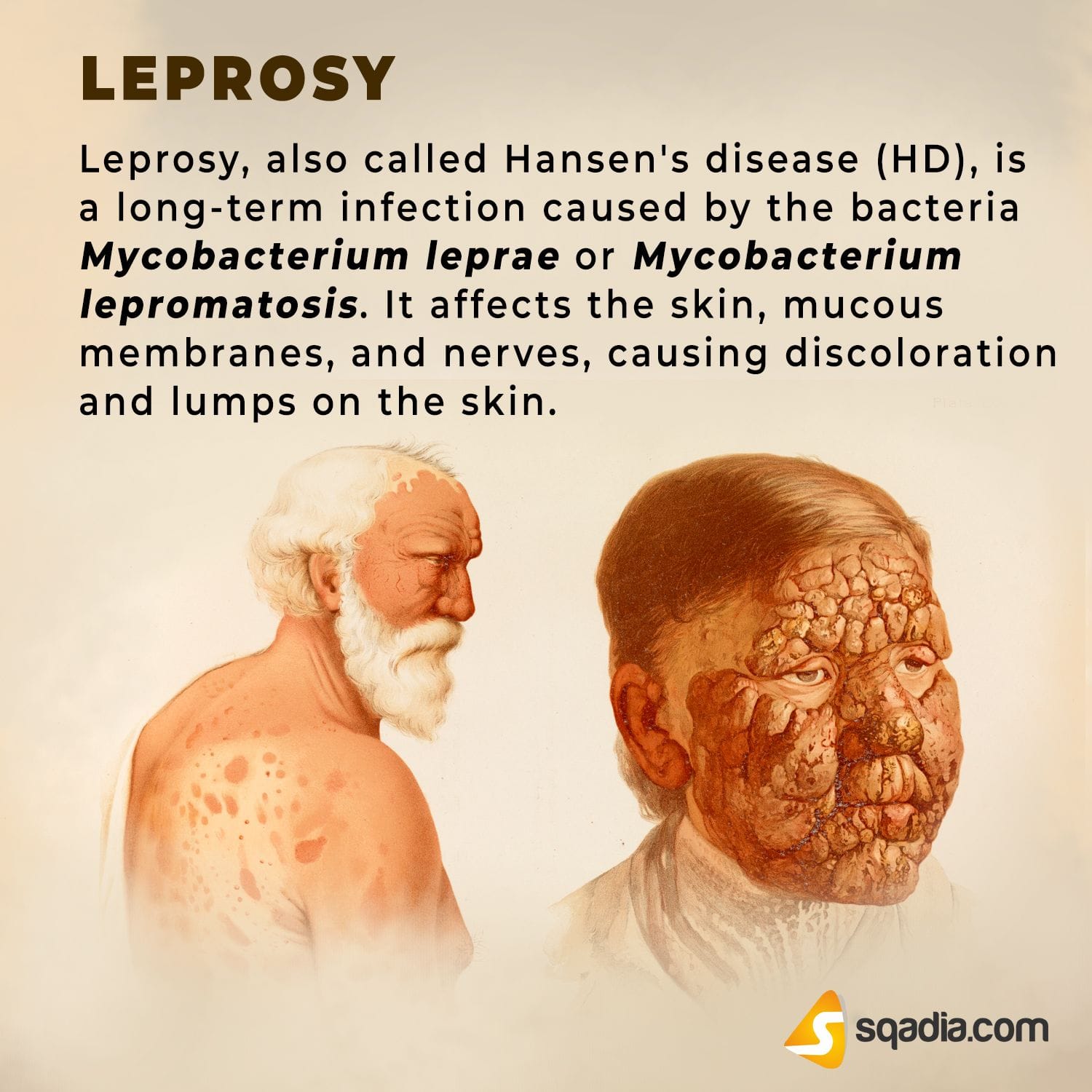 Unraveling the Peculiar Roots of Leprosy